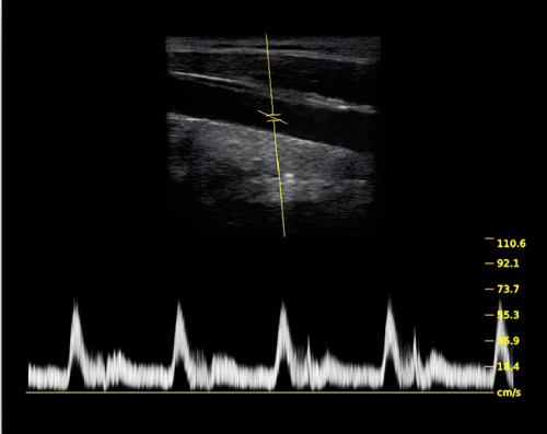2D with PW Doppler
