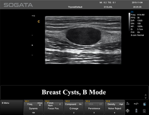 Auto Breast Detection