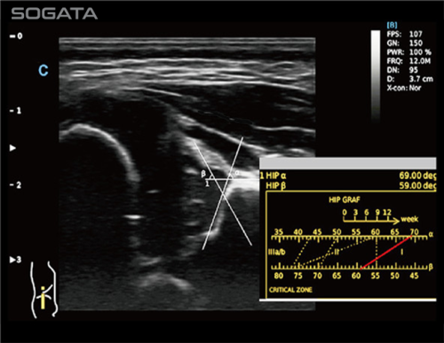 Smart HIP