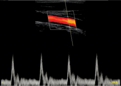 Carotid PW Mode