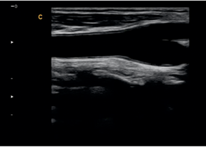 Carotid Sinus, B Mode