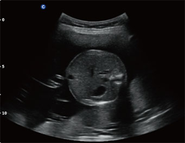 Fetal Abdomen