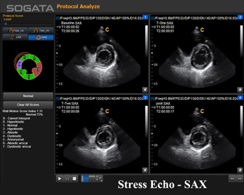 Stress Echo