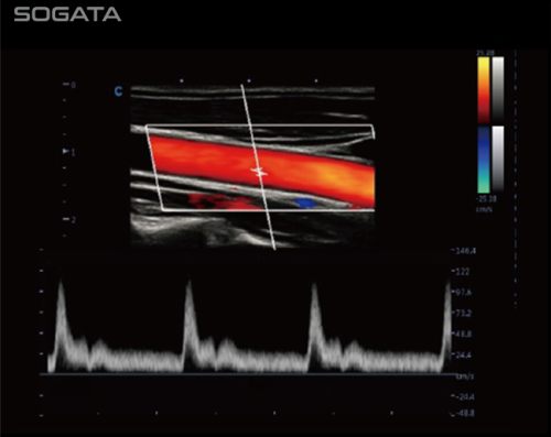 2D with Color Doppler