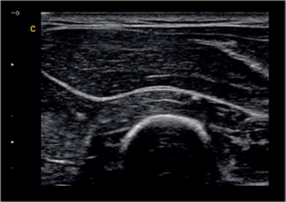 Musculoskeletal B Mode