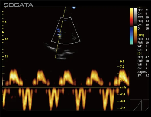 Tissue Doppler Imaging (TDI)