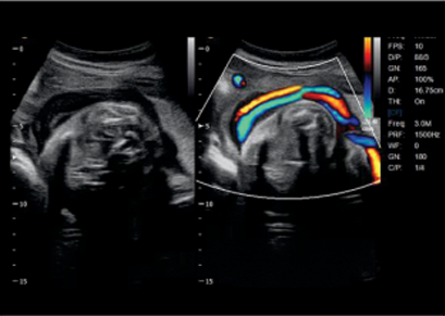 Umbilical Cord, 2B Mode