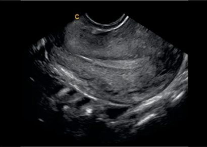 Uterus B Mode
